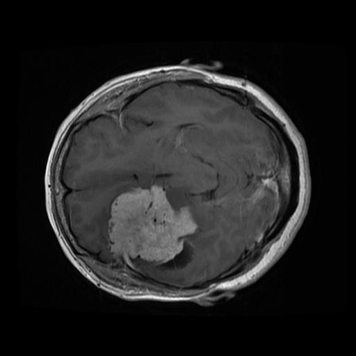 2 Brain Tumor Detection Using Python + ML