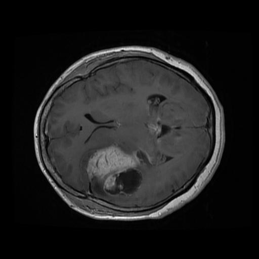 3 Brain Tumor Detection Using Python + ML