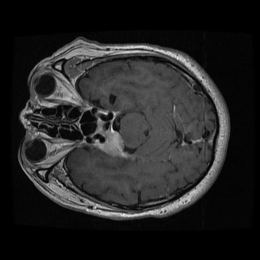 4 Brain Tumor Detection Using Python + ML